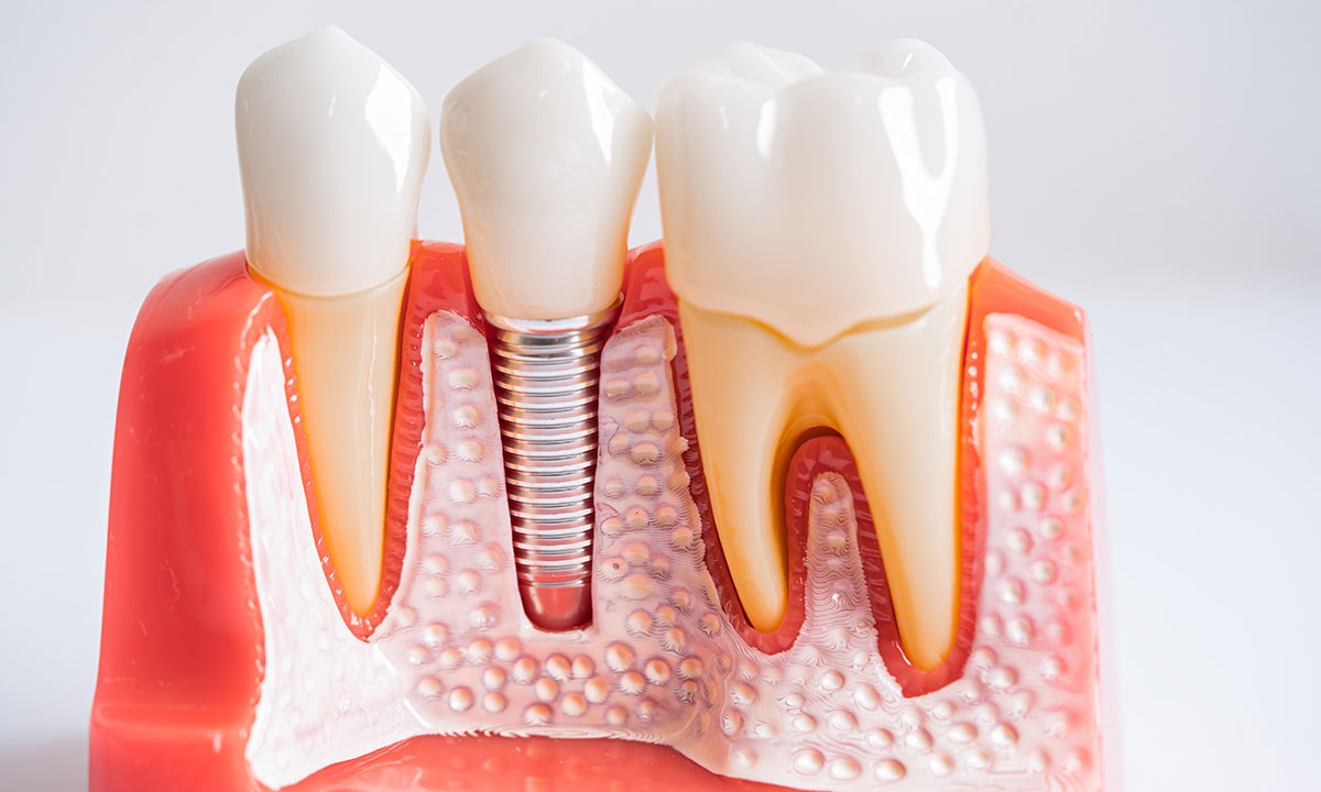 Dental implant restoration and tooth replacement services at Outlook Dental in McKinney, TX - permanent solution for missing teeth