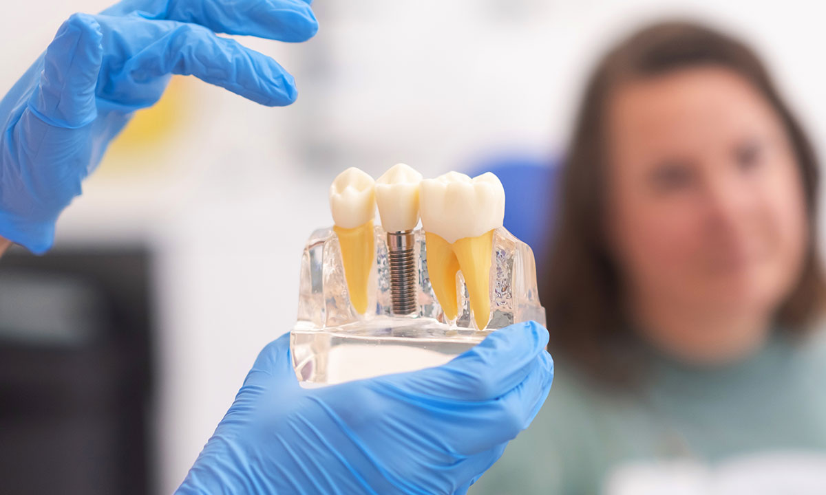 Single tooth dental implant treatment and natural-looking restorations at Outlook Dental in McKinney, TX